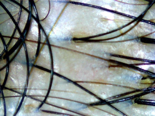 Dandruff Treatment Salon in Singapore Effective