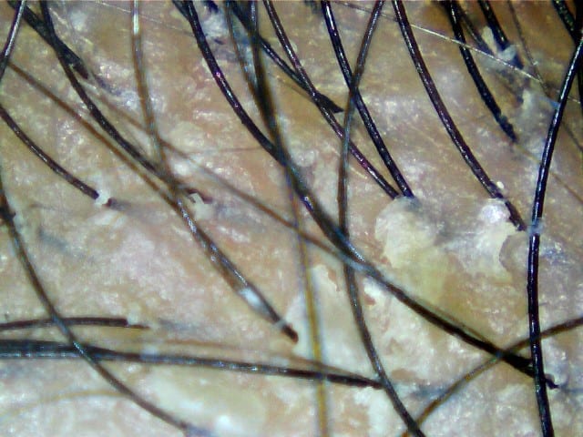 Dandruff Treatment Salon in Singapore