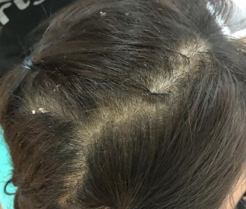 Dandruff treatment — close-up of dark hair showing dandruff on the scalp