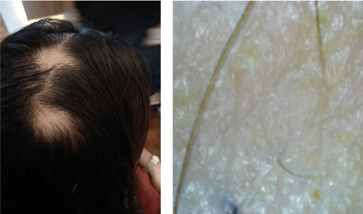 Hair loss caused by alopecia areata with hair scan