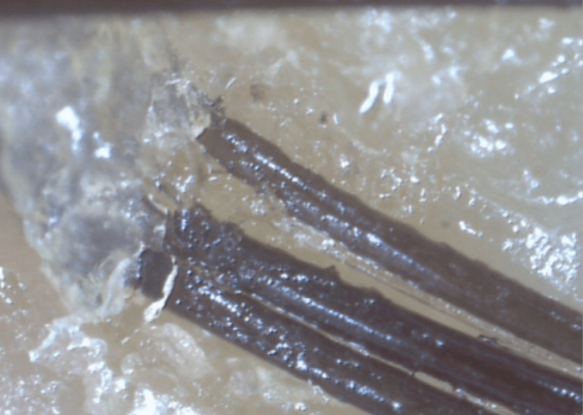 Example of clogged hair pore