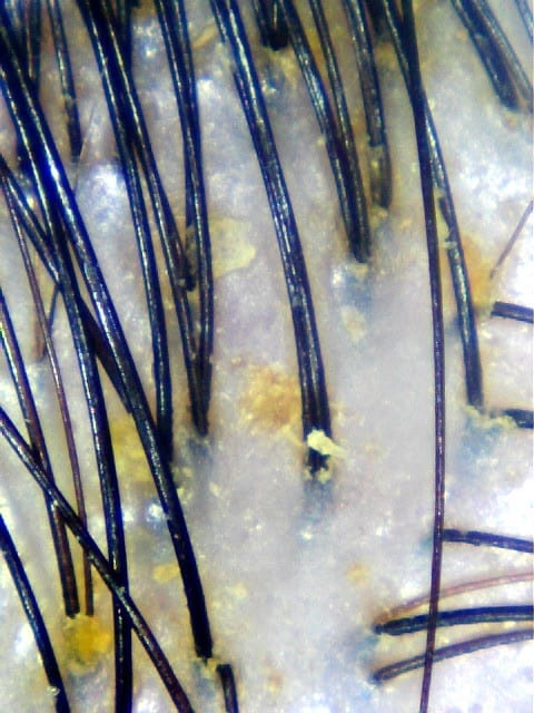 example of oil accumulation on scalp