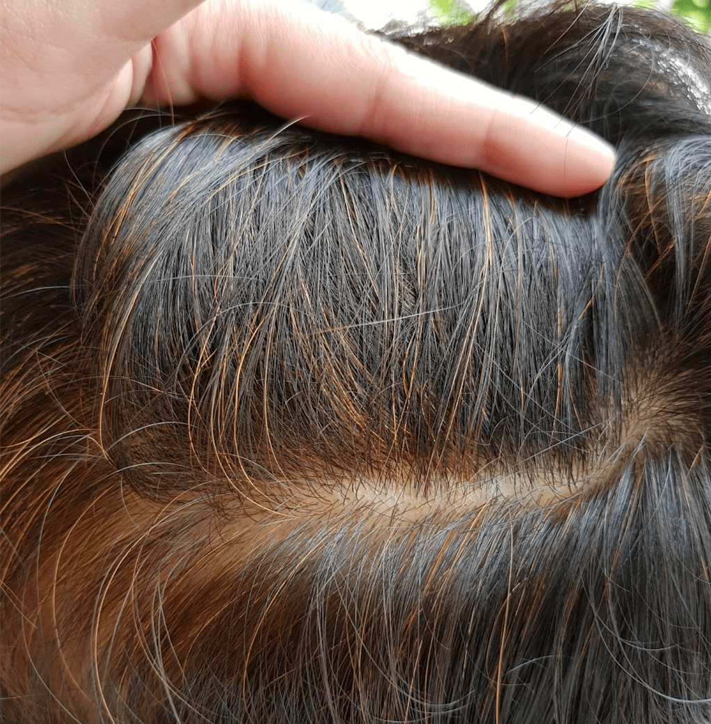 Immediately After Treatment